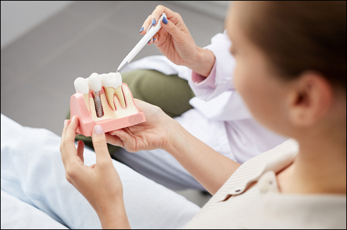 Dental Implant