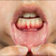 Gum Recession