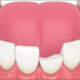 Injured Teeth