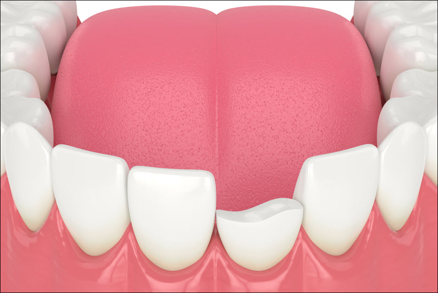 Injured Teeth